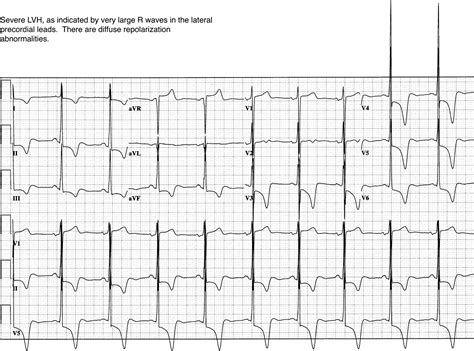 lv medical abbreviation cardiology|severe Lv impairment.